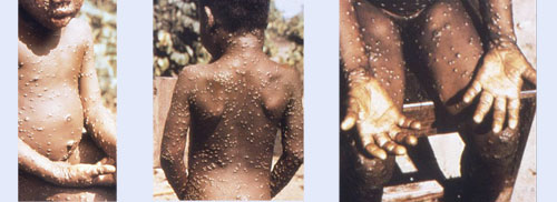 Monkeypox virus infection confirmed in Maryland resident
