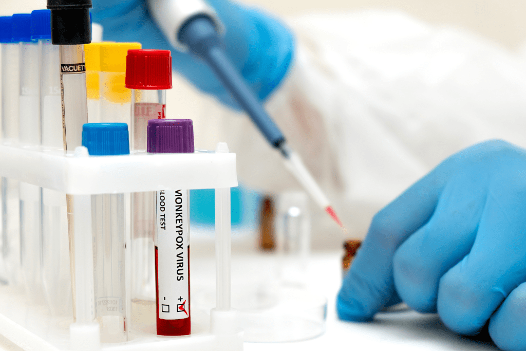 Delaware Division Of Public Health Reports First Case Of Monkeypox In The State