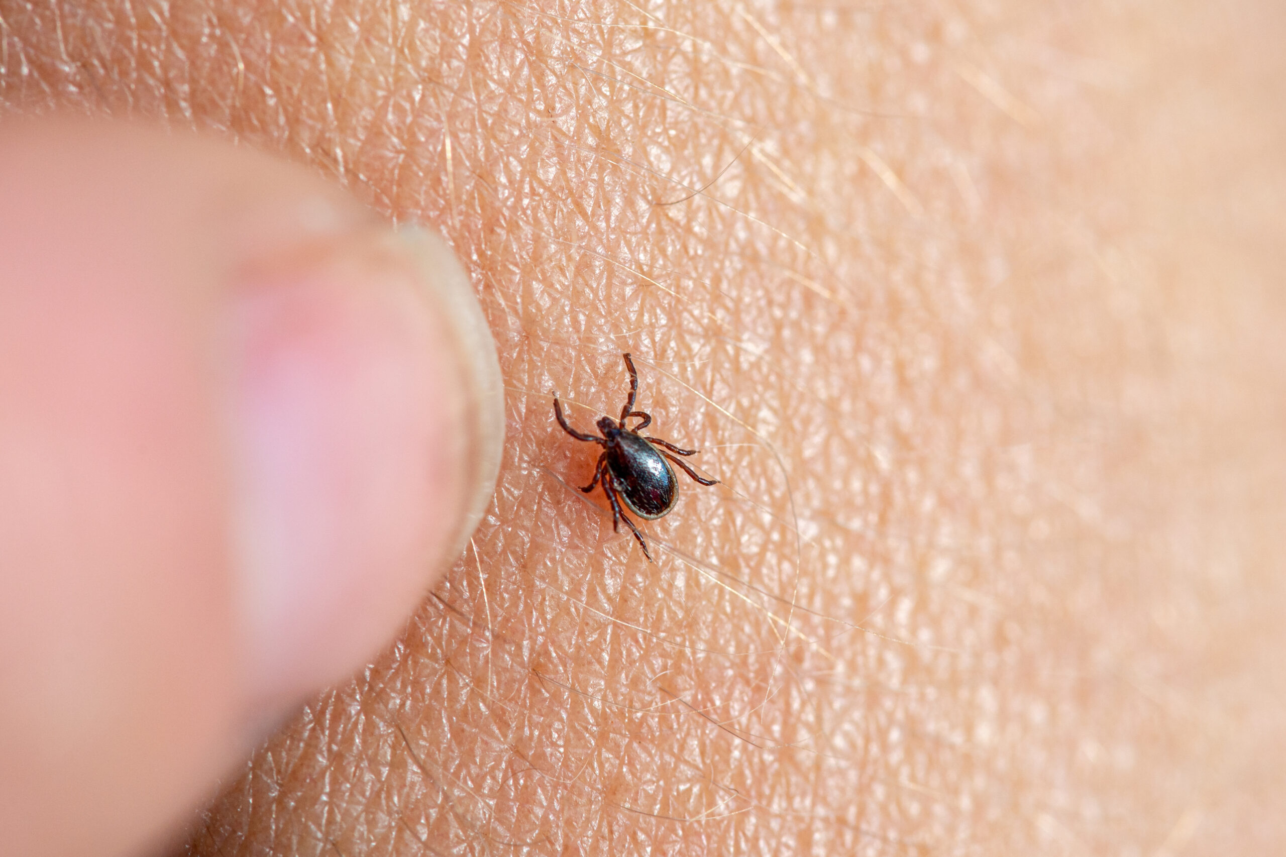 Babesiosis Cases Confirm Growing Tick-Borne Threat in Mid-Atlantic