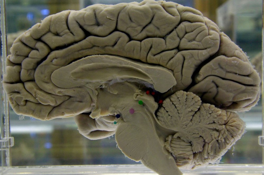 Mental Workouts May Help Protect Against Alzheimer’s Disease, Study Finds