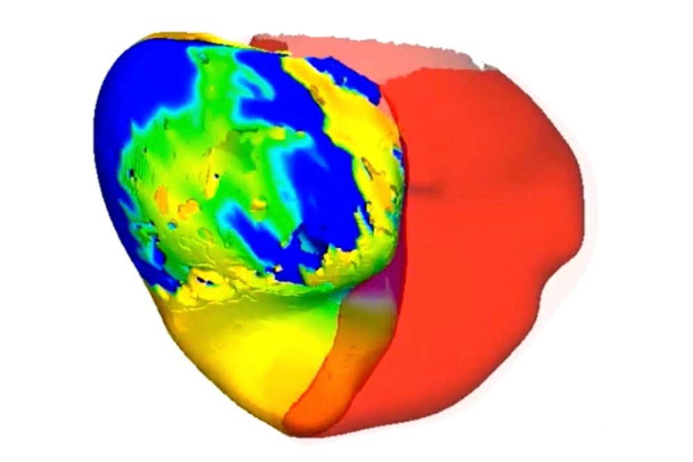 Digital Heart Replicas Help Doctors Target Dangerous Irregular Heartbeats