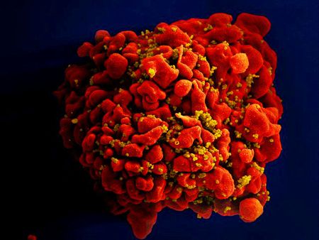 Breakthrough Cell Therapy Shows Promise for HIV Treatment in Early Trial