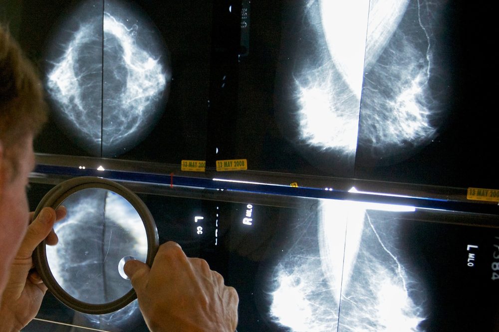 Mixed Guidelines Leave Women Uncertain About Mammogram Timing