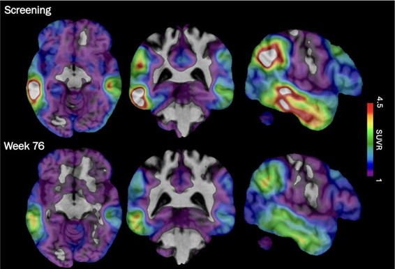 Experimental Drug Targeting Brain Protein Shows Early Promise Against Alzheimer’s