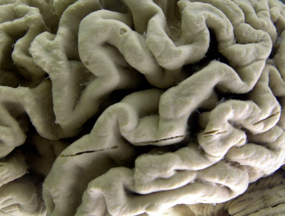 Blood Test May Predict Alzheimer’s Risk Years Before Symptoms Appear