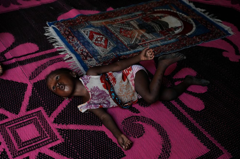 Iran War Sends Shockwaves to Nigerian Children as Malnutrition Spikes